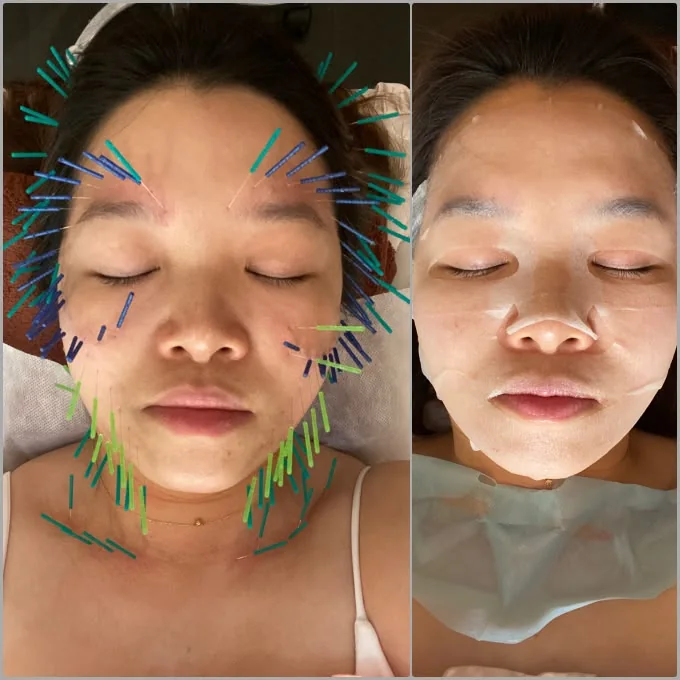 全臉布針與出針後敷面膜