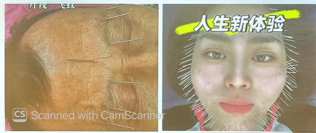 額橫紋平刺與全臉布針