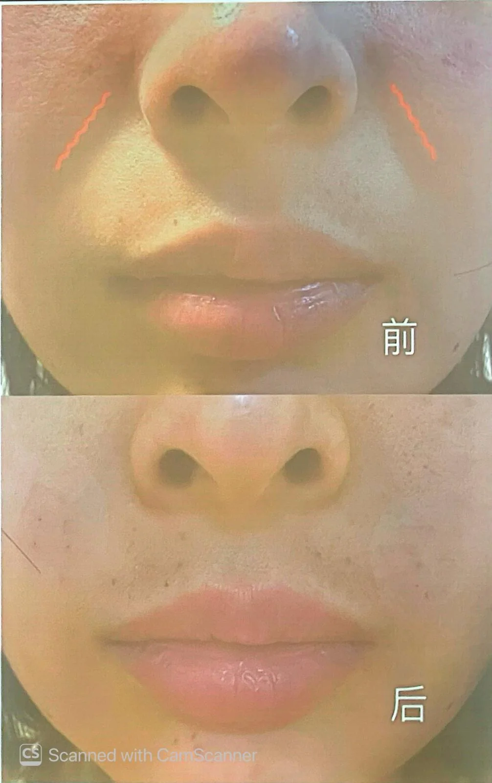 鼻唇溝針前與針後的即時對比